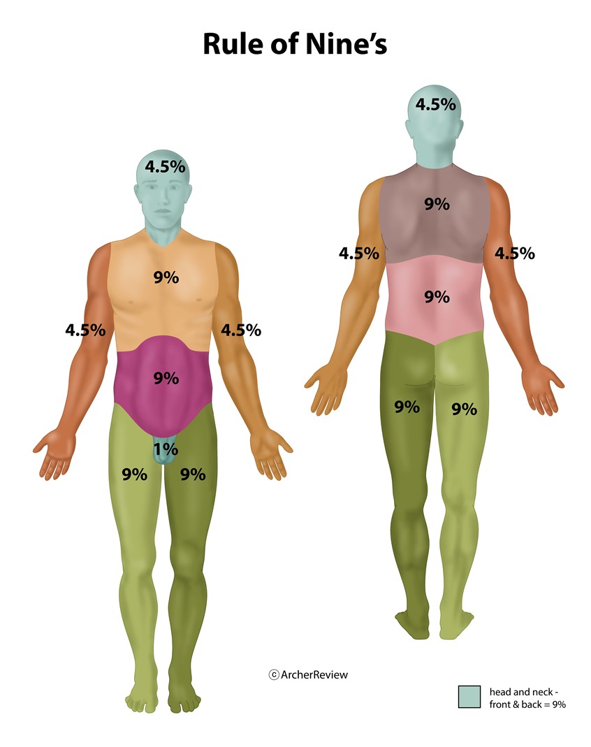 medical illustration of The size of a burn can be quickly estimated by using the