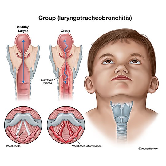 medical illustration of Comparing a healthy larynx with a larynx with croup in pediatric patient
Keywords: croup, larynx, bronchitis, vocal cords