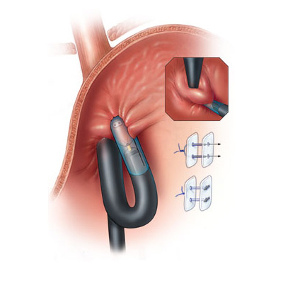 medical illustration of Anatomy, Disease Management, Gastroenterology, General Surgery, Medical Devices, Plastic & Reconstructive Surgery, Thoracic Surgery