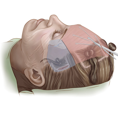 medical illustration of Airbrush, Color, General Surgery, Plastic & Reconstructive Surgery, Portraits