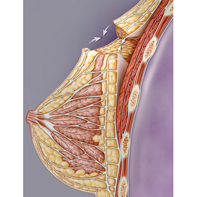 medical illustration of Losken A., Ed. (2009). Partial Breast Reconstruction: Techniques in Oncoplastic Surgery. St Louis, Quality Medical Publishing.