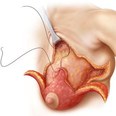 medical illustration of Chapter: Breast Surgery after Massive Weight Loss
