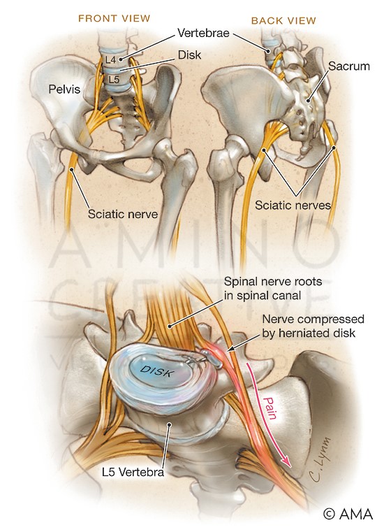 medical illustration of An image created for a JAMA Patient Page on sciatica, showing the effect of a herniated disc on the sciatic nerve, the most common cause of sciatic nerve inflammation and pain.
JAMA. 2009;302(2):216.