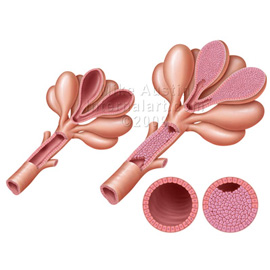 medical illustration of LCIS and DCIS precancerous cells