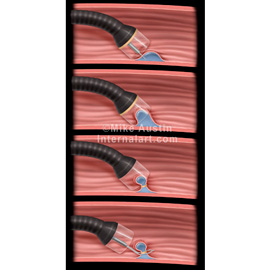 medical illustration of Technique for removing esophageal cancer.