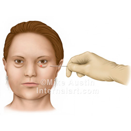 medical illustration of Technique for removing fat from puffy eyes.