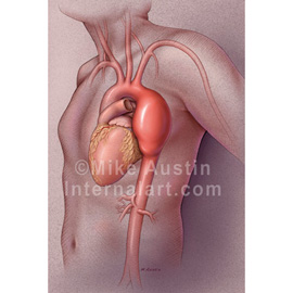 medical illustration of Cover illustration depicting a thoracic aneurysm