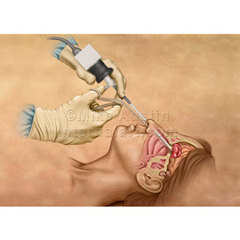 medical illustration of Mini-invasive endoscopic brain surgery