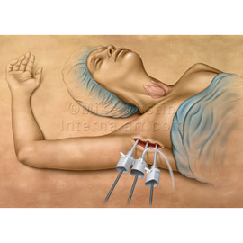 medical illustration of Alternative approach for thyroidectomy leaving no neck scar.