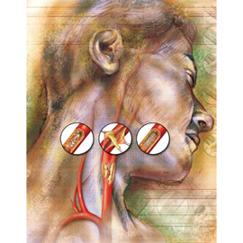 medical illustration of Color, Design, Anatomy, Cardiac Surgery / Cardiology, Medical Devices, Vascular Surgery