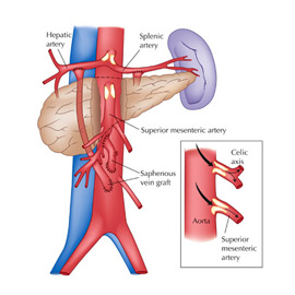 medical illustration of Color, Design, Line, Line with Color, Anatomy, Cardiac Surgery / Cardiology, Vascular Surgery