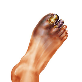 medical illustration of Gangrene in toes as result of diabetes. Precursor to amputation