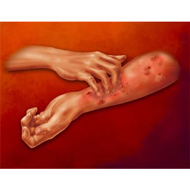 medical illustration of Airbrush, Color, Allergy / Immunology, Anatomy, Dermatology, Disease Management, General Medicine