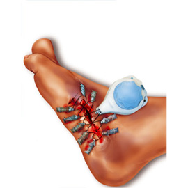 medical illustration of Emerging advances in wound closure using Derm Close