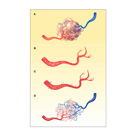 medical illustration of Color, Design, Anatomy, Disease Management, Vascular Surgery