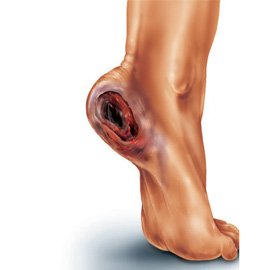 medical illustration of Airbrush, Color, Disease Management, General Medicine, Vascular Surgery