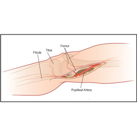 medical illustration of Incision in medial thigh revealing popliteal artery