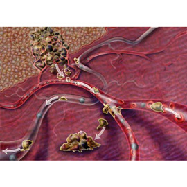 medical illustration of When a cancer progresses, cells gain motility and begin to move away from the original tumor, advancing the disease and making it much more difficult to treat. Created for CR magazine.