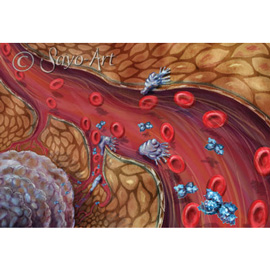 medical illustration of Historically, drug trials judged the efficacy of a new drug by looking at its ability to cure the given disease. Increasingly, surrogate endpoints are used as gauges for drug value. Examples are shown here for cancer research, including: tumor size, metastasis and cancer cell mobility and tumor antigens in the blood stream. Created for CR magazine