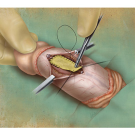 medical illustration of Color, General Surgery, Urology