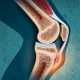 medical illustration of Color, Disease Management, General Medicine, Orthopaedics, Pediatrics, Physical Therapy