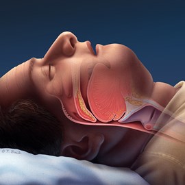 medical illustration of Color, Disease Management, General Medicine, Respiratory