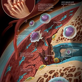 medical illustration of Color, Allergy / Immunology, Cell biology / Histology, Disease Management, Orthopaedics