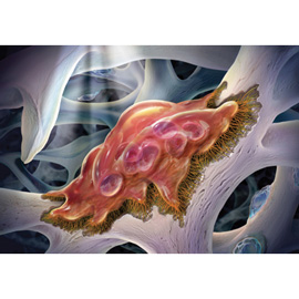 medical illustration of Both bone resorption by an osteoclast, and new bone deposition by osteoblasts, have been featured within this cancellous bone environment.