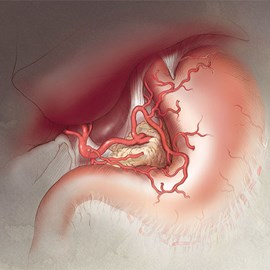 medical illustration of Branches of the Celiac Trunk