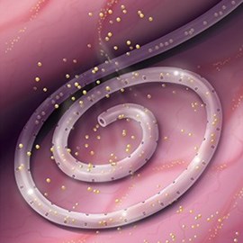 medical illustration of Pigtail Catheter used in Peritoneal Dialysis. Toxins being Absorbed from within the Peritoneal Space