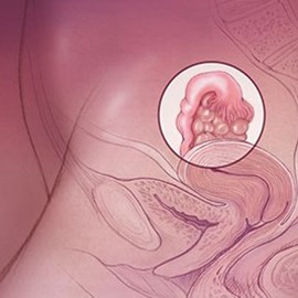 medical illustration of Polycystic Ovaries