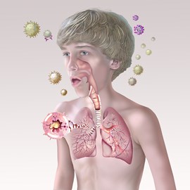 medical illustration of Color, Allergy / Immunology, Emergency Medicine, Pediatrics, Pharmacology, Respiratory