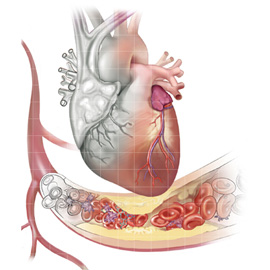 medical illustration of Cardiac Surgery / Cardiology, Vascular Surgery