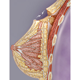 medical illustration of Losken A., Ed. (2009). Partial Breast Reconstruction: Techniques in Oncoplastic Surgery. St Louis, Quality Medical Publishing.