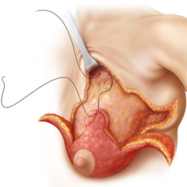 medical illustration of Chapter: Breast Surgery after Massive Weight Loss