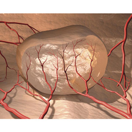 medical illustration of Three-dimensional / Models, Disease Management, Pharmacology, Vascular Surgery