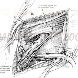 medical illustration of One in a series for Hernia Repair Operation