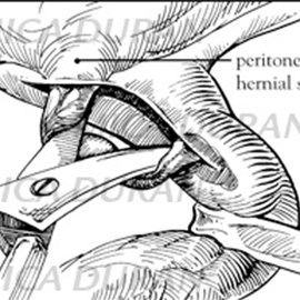 medical illustration of Dissecting hernia out of the spermatic cord