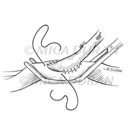 medical illustration of One in a series for Surgical Techniques Book