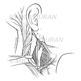 medical illustration of One in a series for Surgical Techniques Book