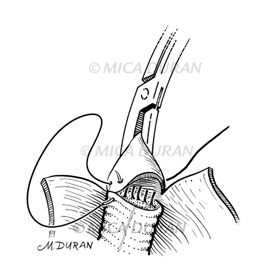 medical illustration of One in a series or Surgical Techniques Book