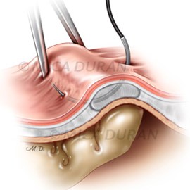 medical illustration of Plate from surgical training guide for Anterior Vaginal Defect Repair