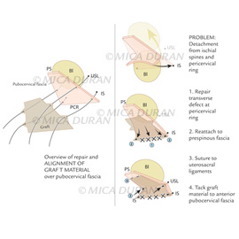 medical illustration of Plate from surgical training guide for Anterior Vaginal Defect Repair