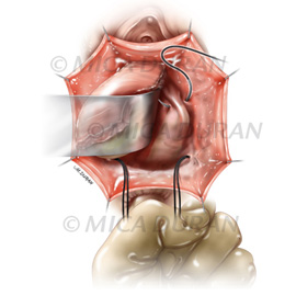 medical illustration of Plate from surgical training guide for Anterior Vaginal Defect Repair