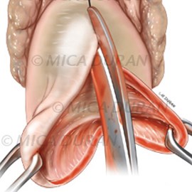 medical illustration of Plate from surgical training guide for Anterior Vaginal Defect Repair
