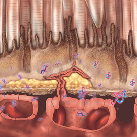 medical illustration of Part of a series of images describing pathological progression of macular degeneration.
