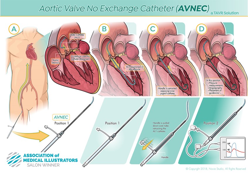 medical illustration of This illustration was made to highlight a new catheter device and its implementation in the heart anatomy for a marketing/advertising audience.