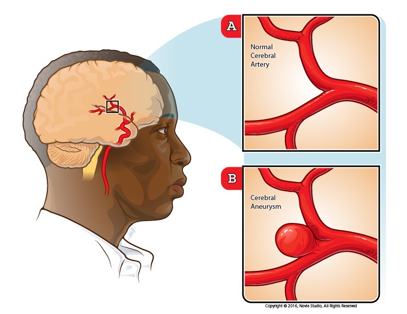 medical illustration of This is a patient education piece meant to illustrate a normal cerebral artery compared to an aneurysm in the same artery.