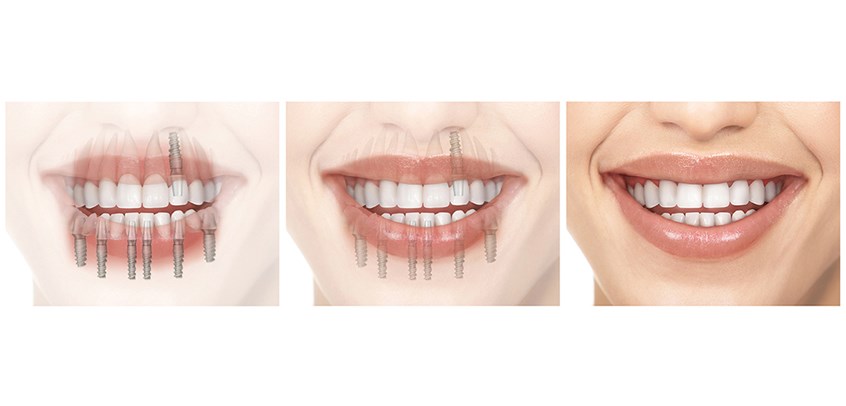 medical illustration of The dental implants are placed, and over time they become completely integrated with the bone tissue.
When the bridge is ready, the dentist simply attaches it to the dental implants.