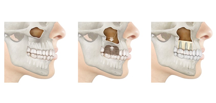 medical illustration of Maxillary sinuses are air-filled cavities that lie close to the upper back teeth. Sometimes there isn’t enough upper jaw bone for dental implants due to maxillary sinus enlargement. A sinus lift is a surgical procedure that lifts the floor of the sinus to create adequate space for graft materials and implants.
